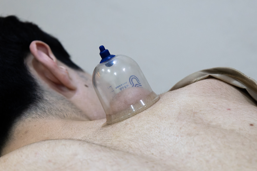 ウェルネスプログラムでのカッピング療法